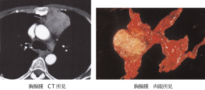 胸腺腫　CT所見　