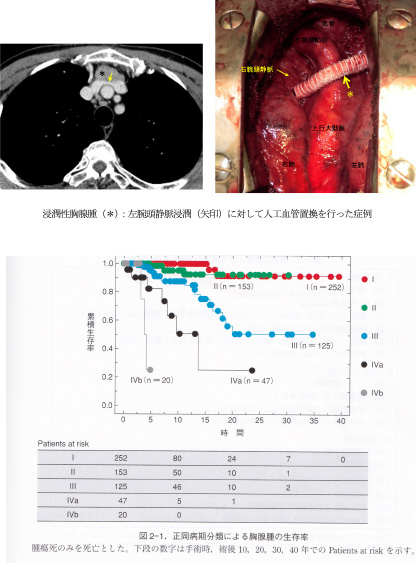 浸潤性胸腺腫（＊）：左腕頭静脈浸潤（矢印）に対して人工血管置換を行った症例<br />